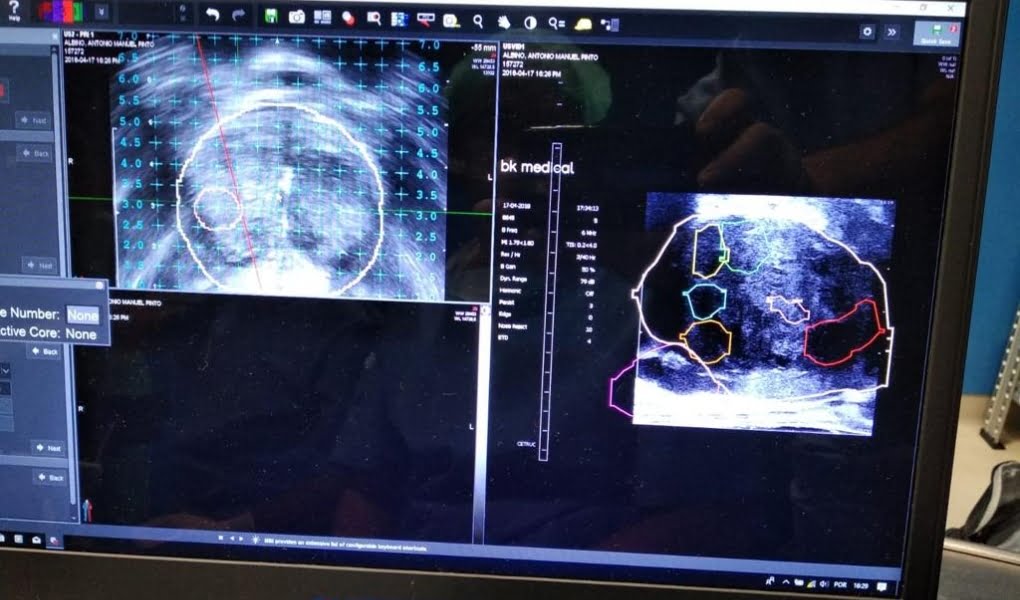 Imagem apresenta Biópsia de Fusão da Próstata