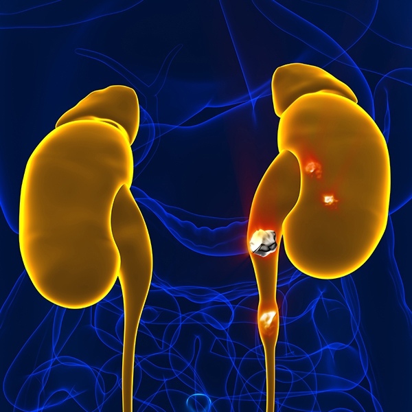 kidneystone-laser-lithotripsy