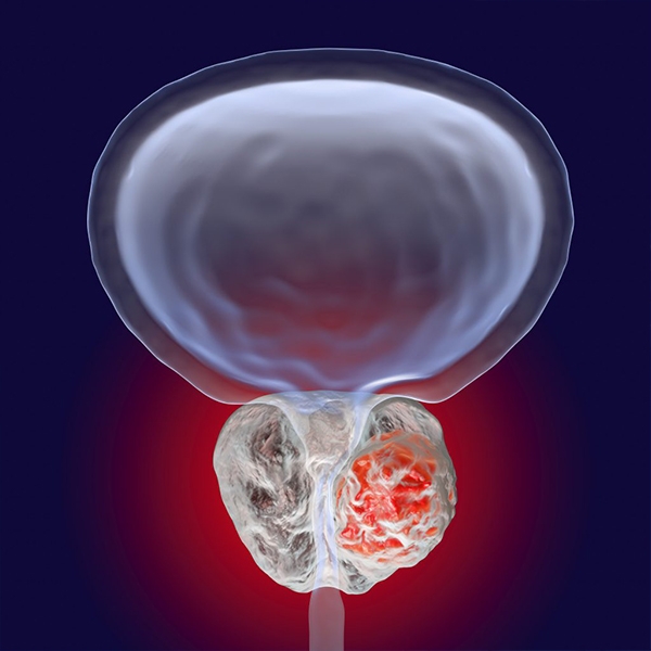 prostate-brachytherapy