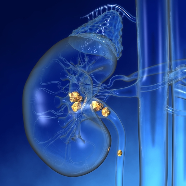 shockwave-lithotripsy